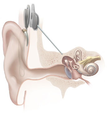 A diagram of a cochlear implant, showing the inner ear Photo by Penn State/CC, Flickr